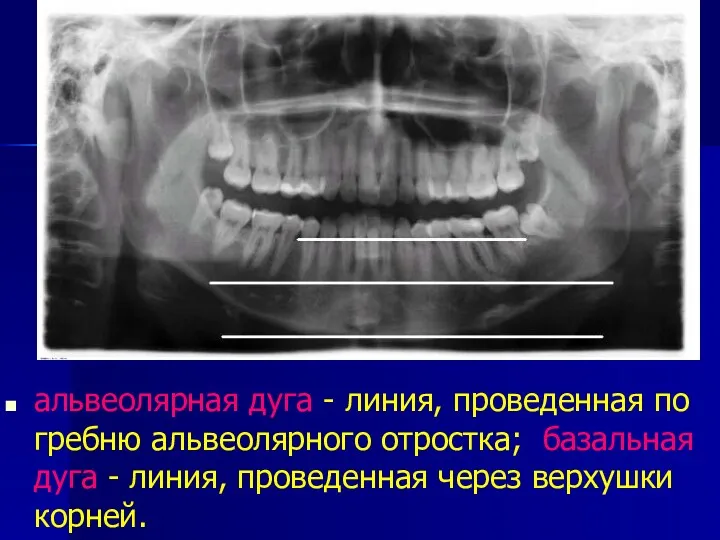 альвеолярная дуга - линия, проведенная по гребню альвеолярного отростка; базальная