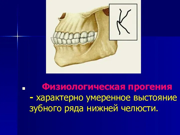 Физиологическая прогения - характерно умеренное выстояние зубного ряда нижней челюсти.