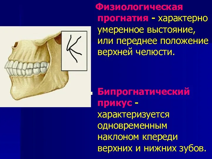 Физиологическая прогнатия - характерно умеренное выстояние, или переднее положение верхней