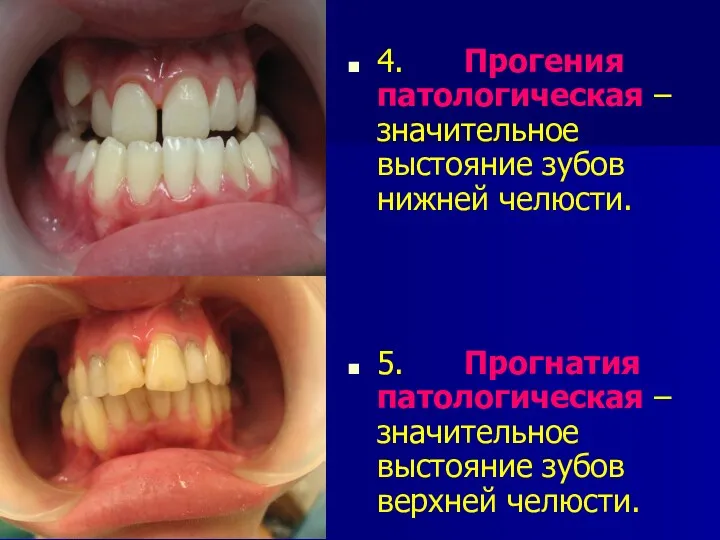 4. Прогения патологическая – значительное выстояние зубов нижней челюсти. 5.