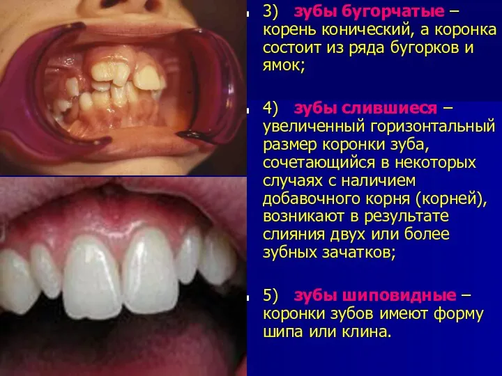 3) зубы бугорчатые – корень конический, а коронка состоит из