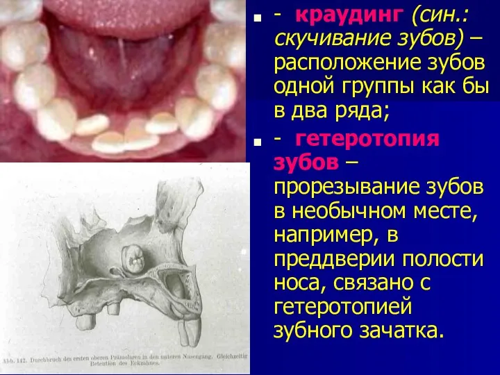 - краудинг (син.: скучивание зубов) – расположение зубов одной группы