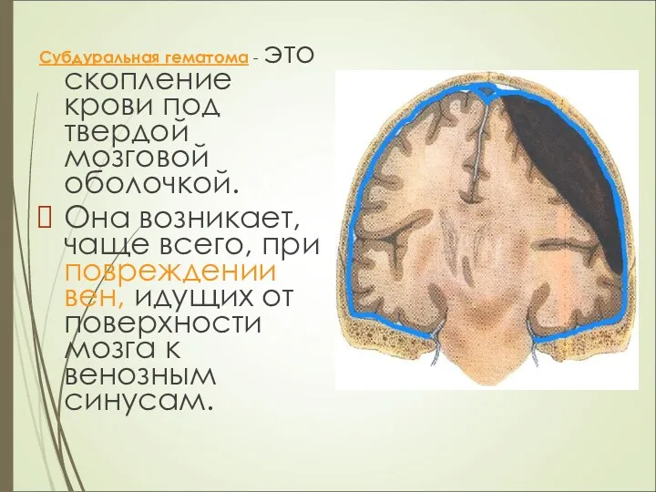 Субдуральная гематома - это скопление крови под твердой мозговой оболочкой. Она возникает, чаще