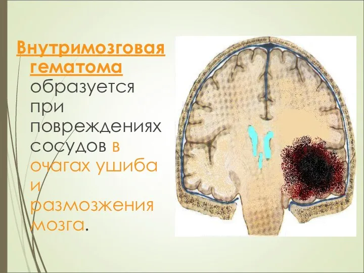 Внутримозговая гематома образуется при повреждениях сосудов в очагах ушиба и размозжения мозга.