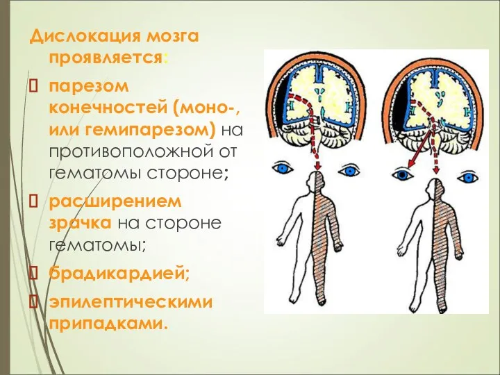 Дислокация мозга проявляется: парезом конечностей (моно-, или гемипарезом) на противоположной от гематомы стороне;