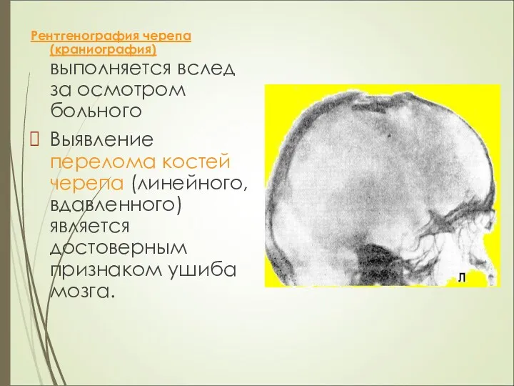 Рентгенография черепа (краниография) выполняется вслед за осмотром больного Выявление перелома костей черепа (линейного,
