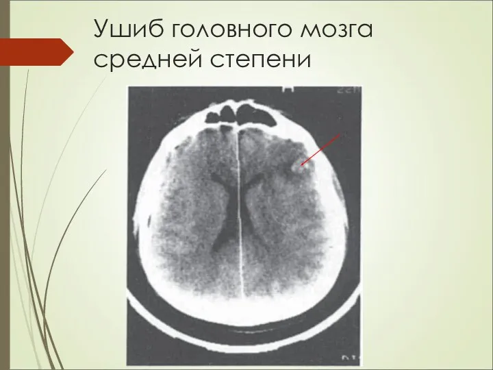 Ушиб головного мозга средней степени