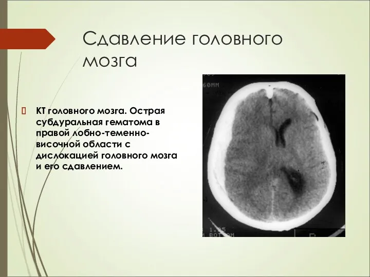 Сдавление головного мозга КТ головного мозга. Острая субдуральная гематома в правой лобно-теменно-височной области