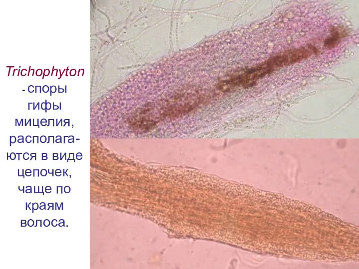 Trichophyton - споры гифы мицелия, располага-ются в виде цепочек, чаще по краям волоса.