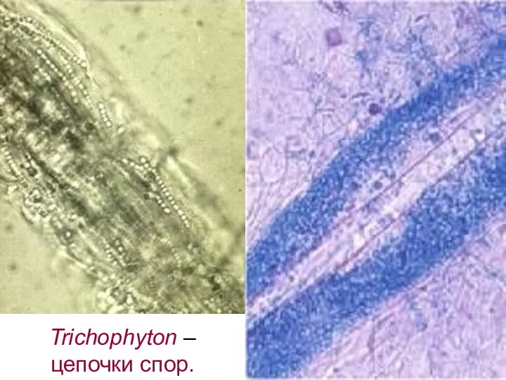 Trichophyton – цепочки спор.