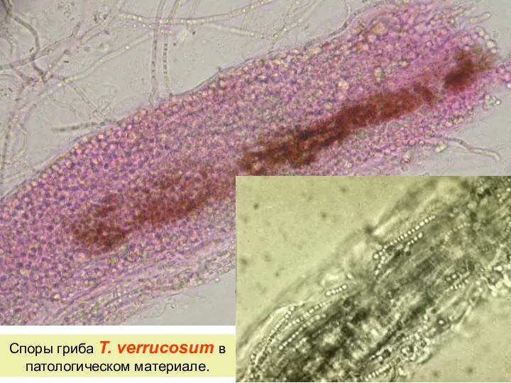 Споры гриба T. verrucosum в патологическом материале.