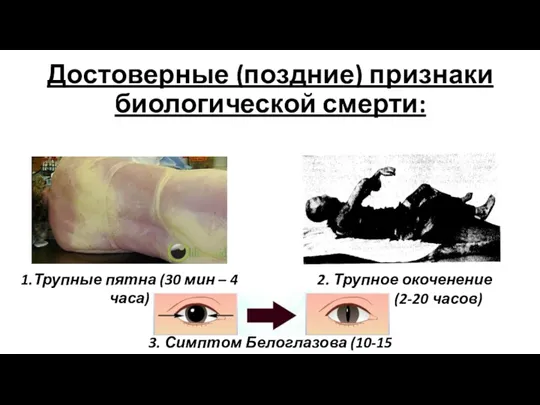 Достоверные (поздние) признаки биологической смерти: 1.Трупные пятна (30 мин –