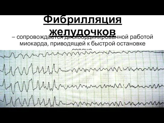 Фибрилляция желудочков – сопровождается дискоординированной работой миокарда, приводящей к быстрой остановке сердца.