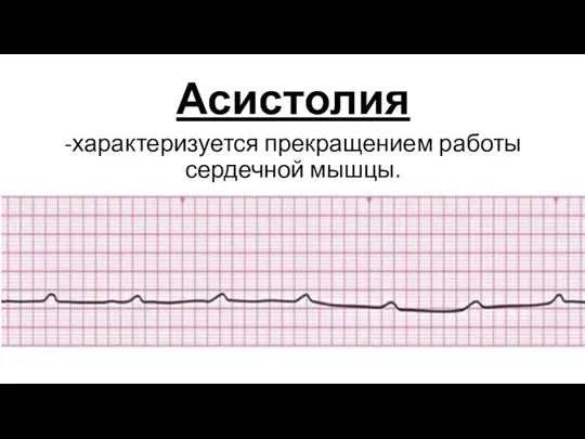 Асистолия -характеризуется прекращением работы сердечной мышцы.