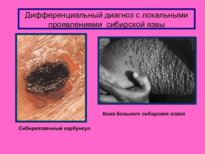 Дифференциальный диагноз с локальными проявлениями сибирской язвы Сибиреязвенный карбункул Кожа больного сибирской язвой