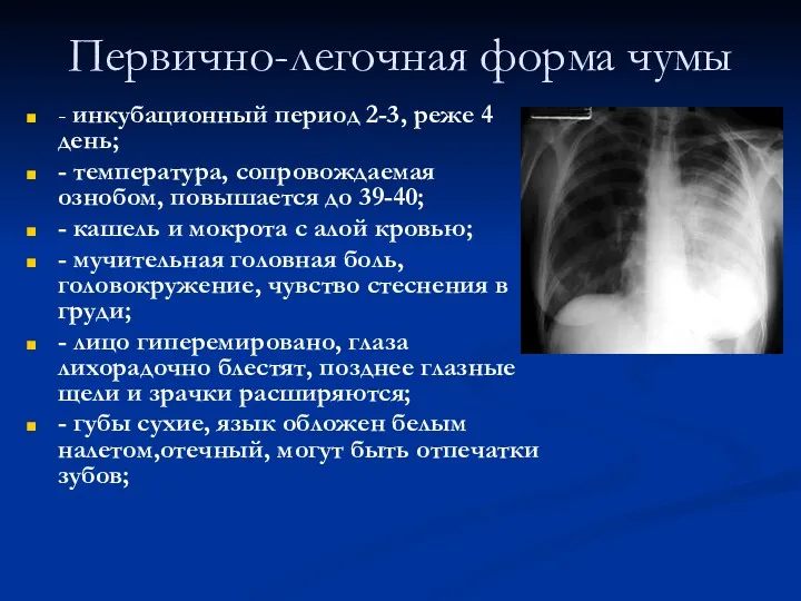 Первично-легочная форма чумы - инкубационный период 2-3, реже 4 день;