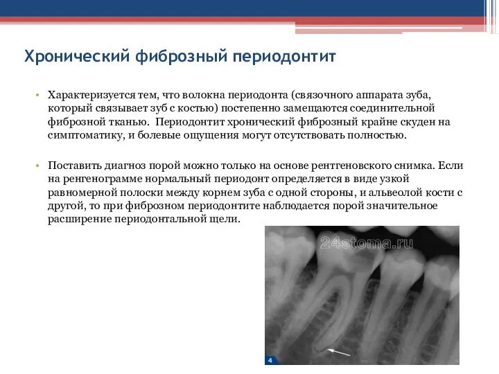 Хронический фиброзный периодонтит Характеризуется тем, что волокна периодонта (связочного аппарата