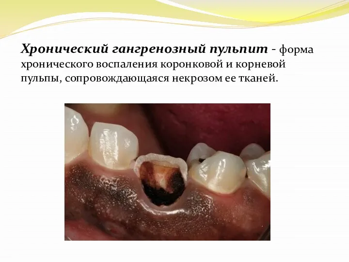 Хронический гангренозный пульпит - форма хронического воспаления коронковой и корневой пульпы, сопровождающаяся некрозом ее тканей.