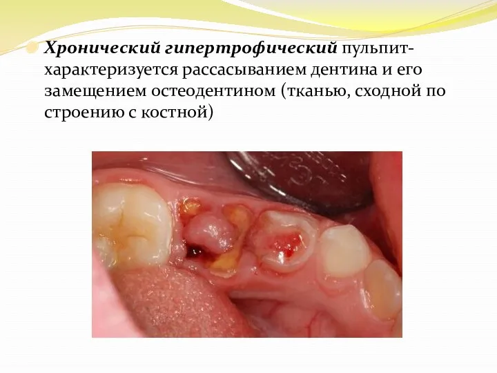 Хронический гипертрофический пульпит-характеризуется рассасыванием дентина и его замещением остеодентином (тканью, сходной по строению с костной)