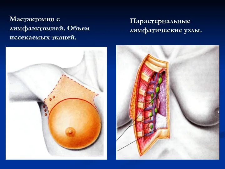 Мастэктомия с лимфаэктомией. Объем иссекаемых тканей. Парастернальные лимфатические узлы.
