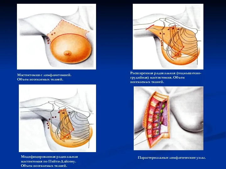 Мастэктомия с лимфаэктомией. Объем иссекаемых тканей. Модифицированная радикальная мастэктомия по Пейти-Дайсену. Объем иссекаемых