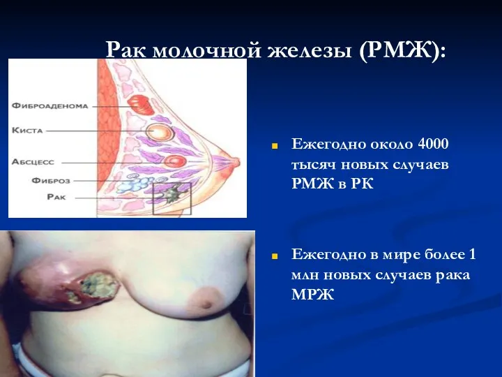 Рак молочной железы (РМЖ): Ежегодно около 4000 тысяч новых случаев РМЖ в РК