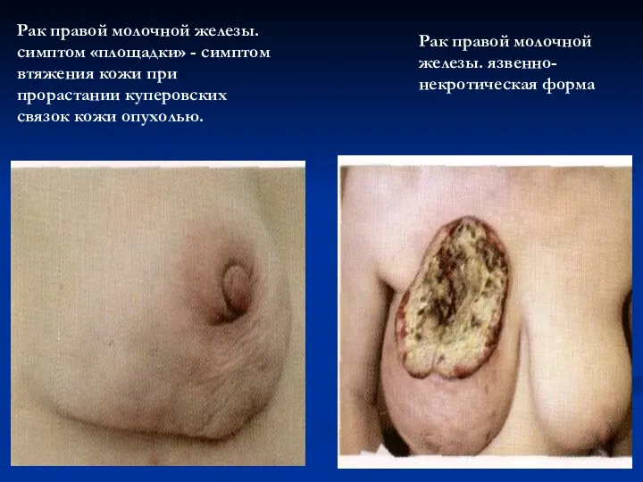 Рак правой молочной железы. симптом «площадки» - симптом втяжения кожи при прорастании куперовских