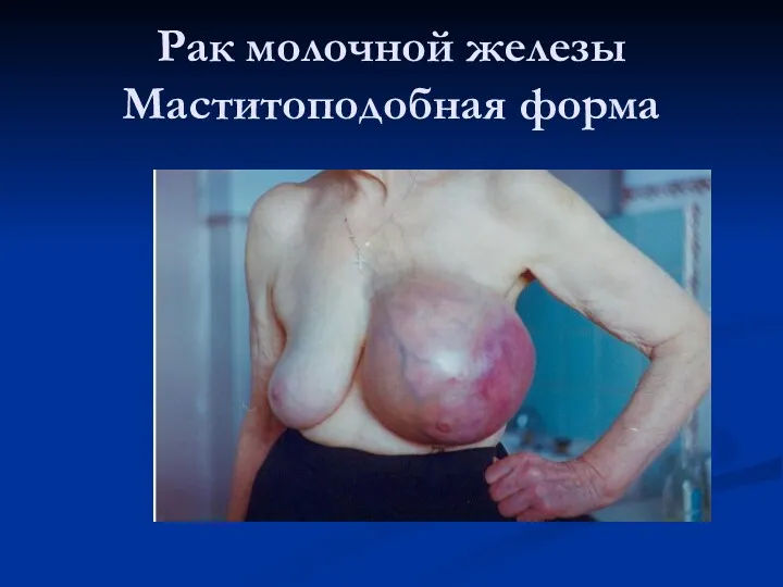 Рак молочной железы Маститоподобная форма
