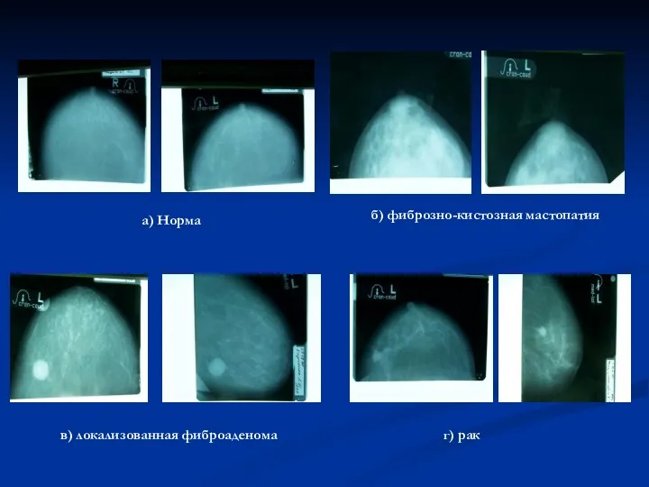 а) Норма б) фиброзно-кистозная мастопатия в) локализованная фиброаденома г) рак
