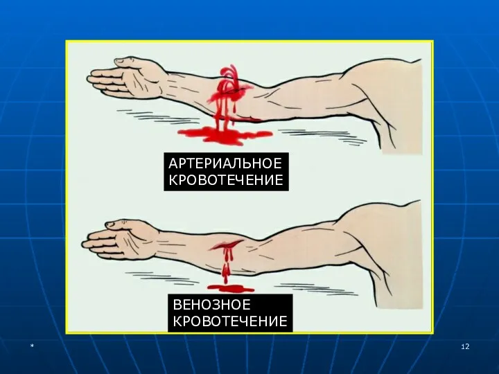 АРТЕРИАЛЬНОЕ КРОВОТЕЧЕНИЕ ВЕНОЗНОЕ КРОВОТЕЧЕНИЕ *