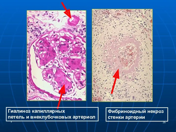 Гиалиноз капиллярных петель и внеклубочковых артериол Фибриноидный некроз стенки артерии *