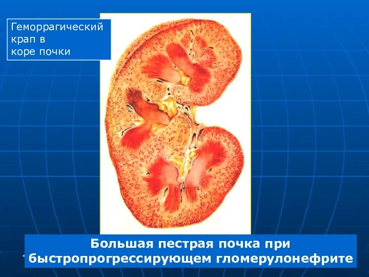 Большая пестрая почка при быстропрогрессирующем гломерулонефрите Геморрагический крап в коре почки *