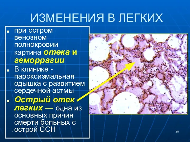 ИЗМЕНЕНИЯ В ЛЕГКИХ при остром венозном полнокровии картина отека и