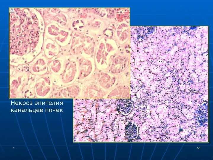 Некроз эпителия канальцев почек *
