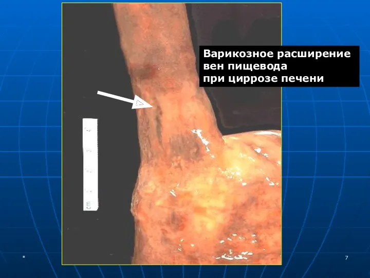 Варикозное расширение вен пищевода при циррозе печени *