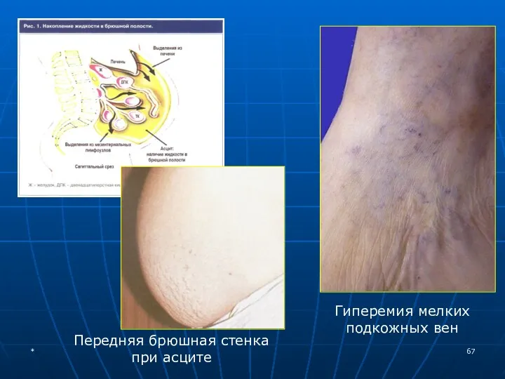 Передняя брюшная стенка при асците Гиперемия мелких подкожных вен *