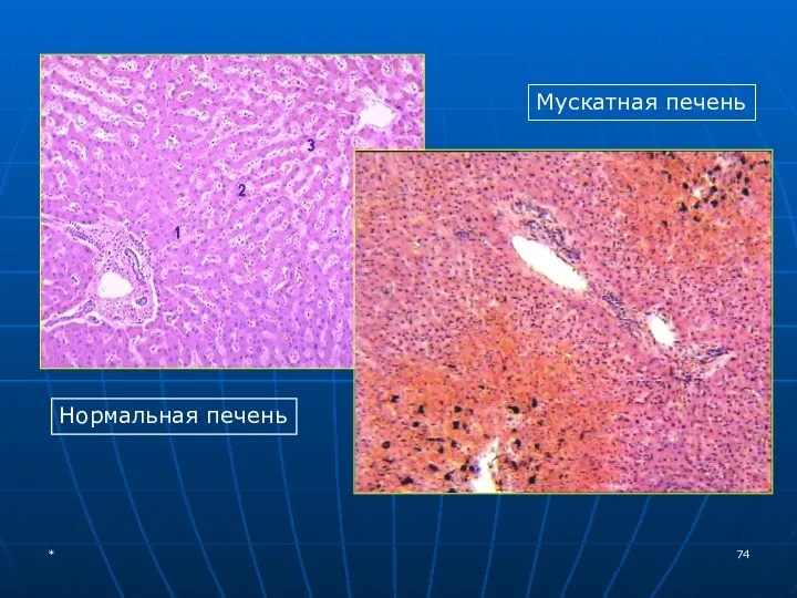 Нормальная печень Мускатная печень *