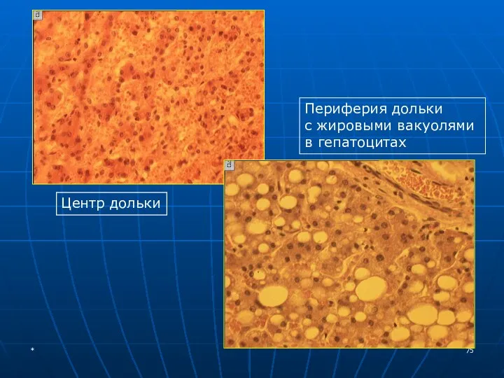 Центр дольки Периферия дольки с жировыми вакуолями в гепатоцитах *