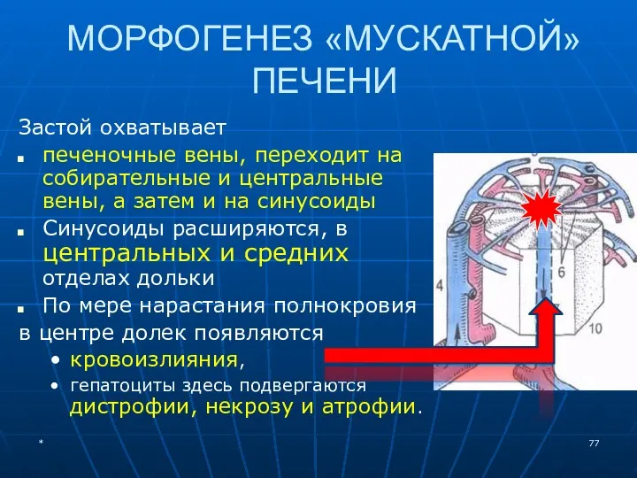 МОРФОГЕНЕЗ «МУСКАТНОЙ» ПЕЧЕНИ Застой охватывает печеночные вены, переходит на собирательные