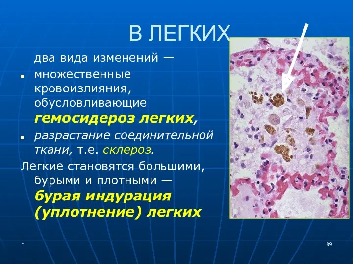 В ЛЕГКИХ два вида изменений — множественные кровоизлияния, обусловливающие гемосидероз легких, разрастание соединительной