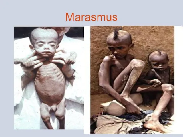 Marasmus