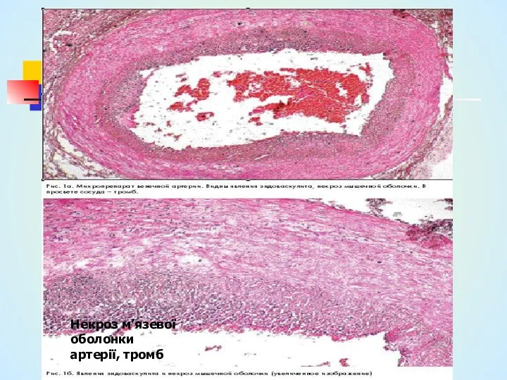 Некроз м’язевої оболонки артерії, тромб