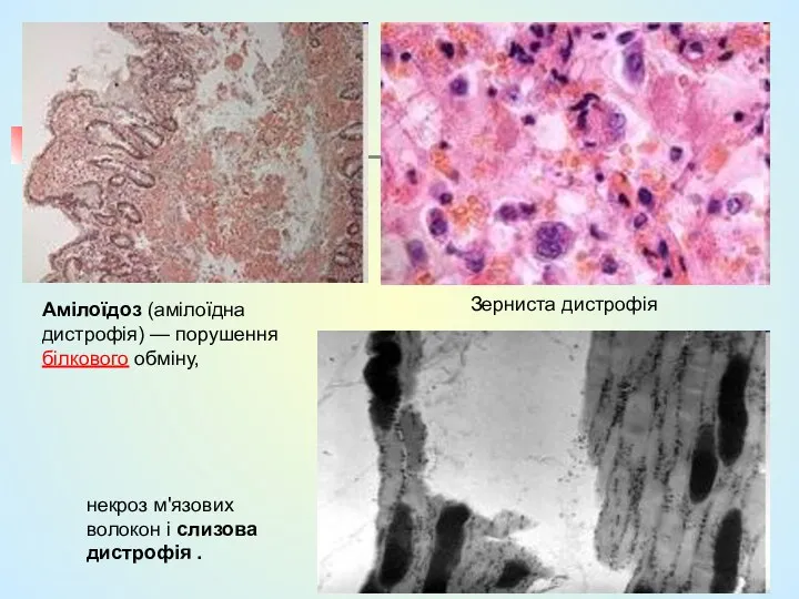 Амілоїдоз (амілоїдна дистрофія) — порушення білкового обміну, Зерниста дистрофія некроз м'язових волокон і слизова дистрофія .