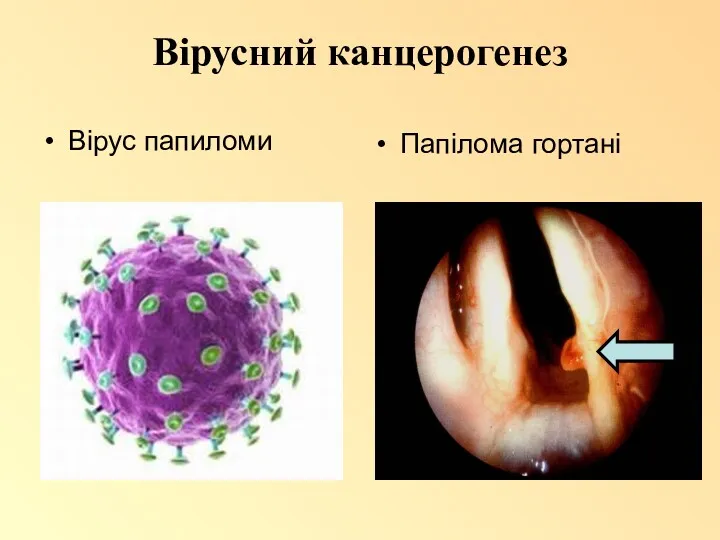 Вірусний канцерогенез Вірус папиломи Папілома гортані