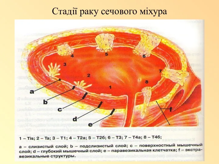 Стадії раку сечового міхура