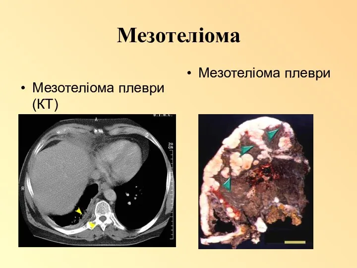 Мезотеліома Мезотеліома плеври(КТ) Мезотеліома плеври