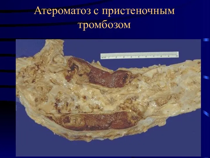 Атероматоз с пристеночным тромбозом