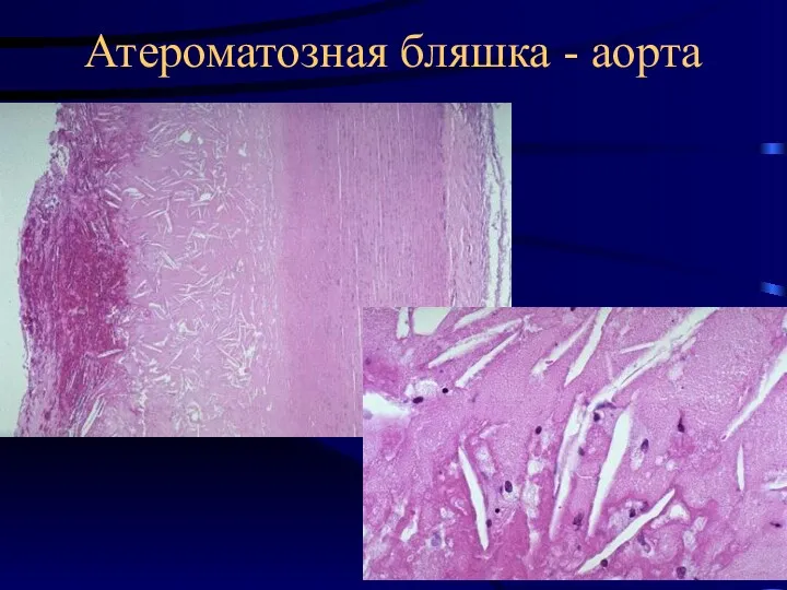 Атероматозная бляшка - аорта
