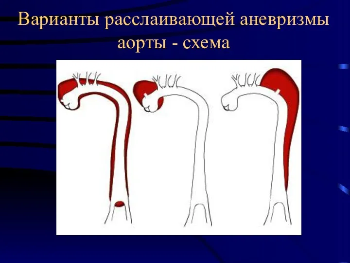 Варианты расслаивающей аневризмы аорты - схема