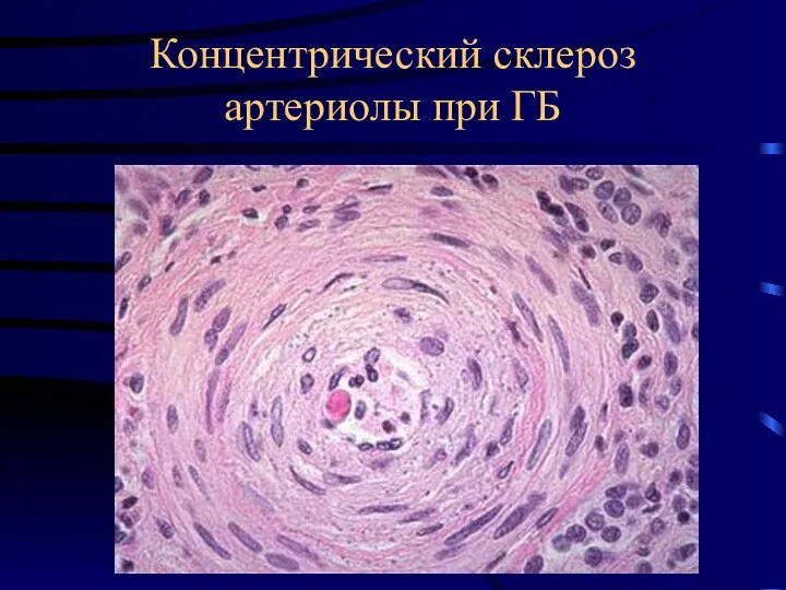 Концентрический склероз артериолы при ГБ